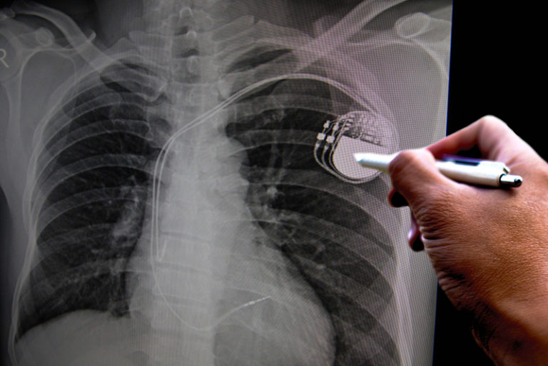 BioPace | Biological Pacemaker